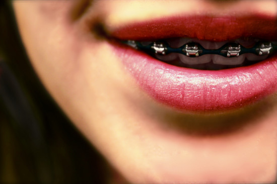 What is the average cost of braces?