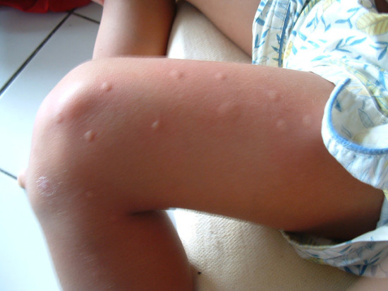 The chikungunya virus from mosquito bites in the US